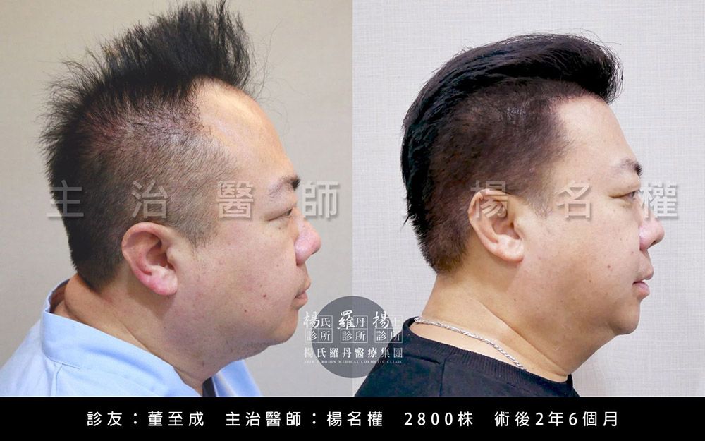 植髮,董哥,董至成,生髮水